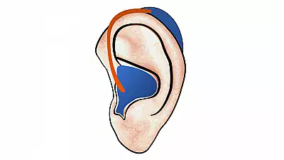 Hörgerät im Ohr